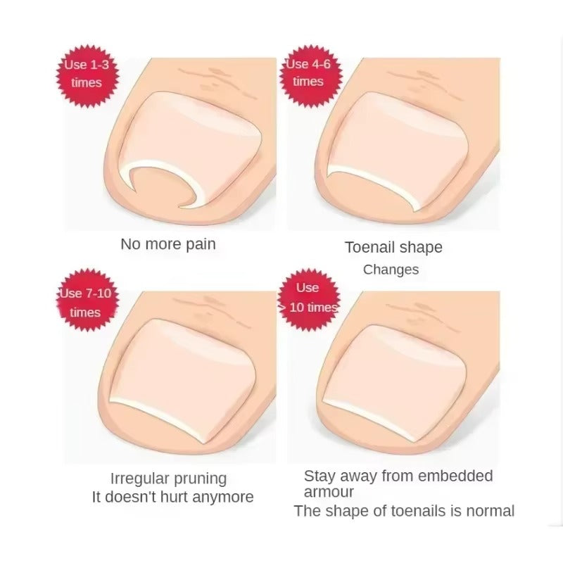 Stainless Steel Ingrown Toenail Corrector designed for precision treatment to relieve discomfort and promote proper nail growth.